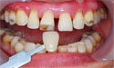 牙齿贴面美白牙齿的方法