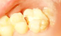 牙髓炎怎么办？如何预防牙髓炎