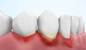 智牙牙龈肿痛怎么处理？为什么会牙痛