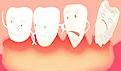 为什么总是晚上牙疼？导致牙痛的原因