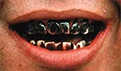 牙齿矫正的方法有哪些？要注意哪些事情