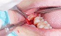 牙龈根部暗红色是什么原因?要注意哪些？