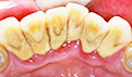 牙齿黄有牙垢怎么办？六种方法可帮忙