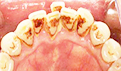 大门牙齿缝隙大的原因 怎么矫正