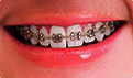 青少年牙齿保健知识 青少年牙齿不齐的严重后果