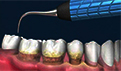 什么是牙齿楔状缺损？严重吗
