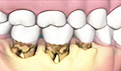 牙龈萎缩是什么原因？6大原因要注意