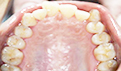 骨性龅牙分几级？骨性龅牙与牙性龅牙的区别