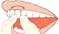 种植牙和一般假牙的区别是什么？种植牙有哪些好处