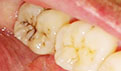 窝沟龋的形成和预防 龋齿很疼怎么办